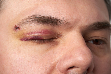 Obraz premium close view of a bruise near the eye, the face of a man with a hematoma