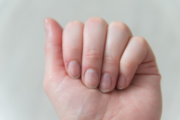 Close up female nails without manicure. Overgrown cuticle fingernails and tainted nail plate. Health and beauty problems