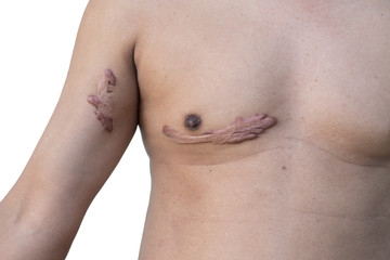 scar from car accident on man body isolated on white background  