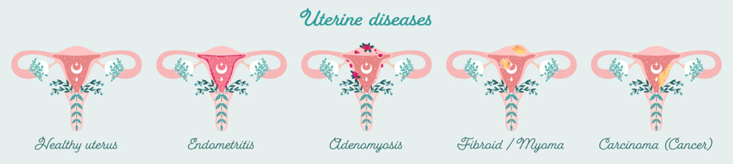Women health - Uterus in flowers diagram. Anatomical schemes Uterine diseases - like adenomyosis, fibroid, cancer e.t.c. Gynecological diseases of womb - Isolated patient-friendly infographic