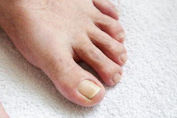 Details of man nails with fungal infection known as onicomycosis, natural light