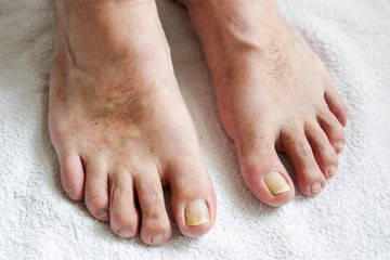 Details of man nails with fungal infection known as onychomycosis, natural light