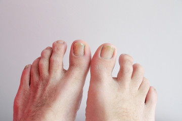 Details of man nails with fungal infection known as onychomycosis, natural light