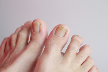 Details of man nails with fungal infection known as onychomycosis, natural light