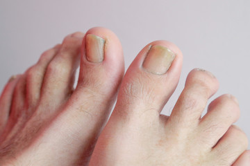 Details of man nails with fungal infection known as onychomycosis, natural light