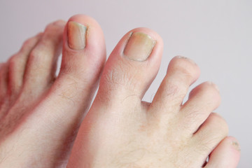 Details of man nails with fungal infection known as onychomycosis, natural light