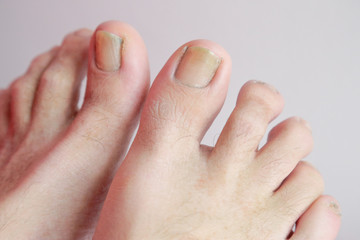 Details of man nails with fungal infection known as onychomycosis, natural light