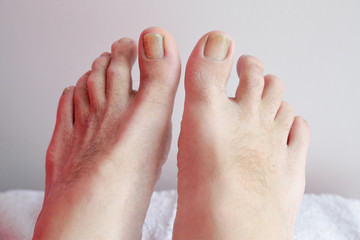 Details of man nails with fungal infection known as onychomycosis, natural light