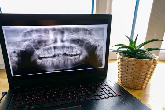 X-ray of teeth, complex dental case, on laptop