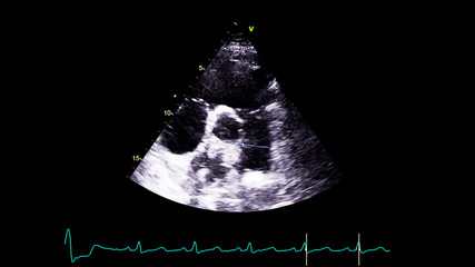Image of the heart in gray-scale mode during transesophageal ultrasound.