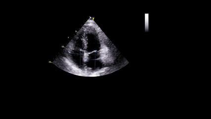 Image of the heart in gray-scale mode during transesophageal ultrasound.