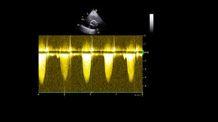 Image of the heart in gray-scale mode during transesophageal ultrasound.
