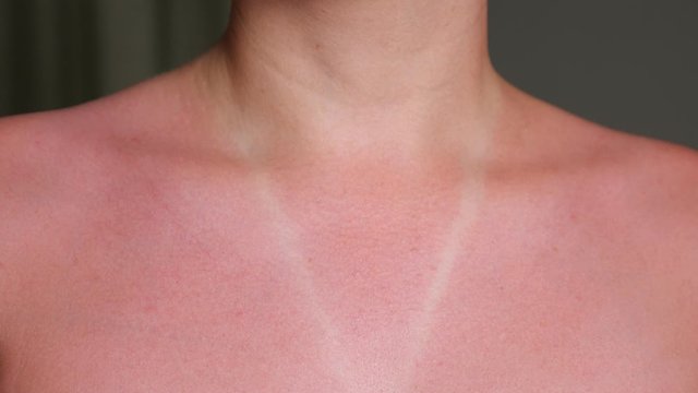 young woman sunburned bare chest and neck with red suntan around white designed swimsuit imprint extreme close view