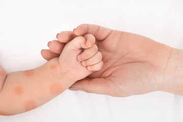 Mother holding her child's hand with red rash, closeup. Baby allergies