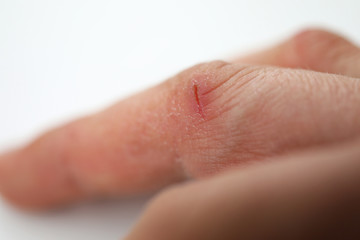 Close-up small wound on finger, dry skin hands
