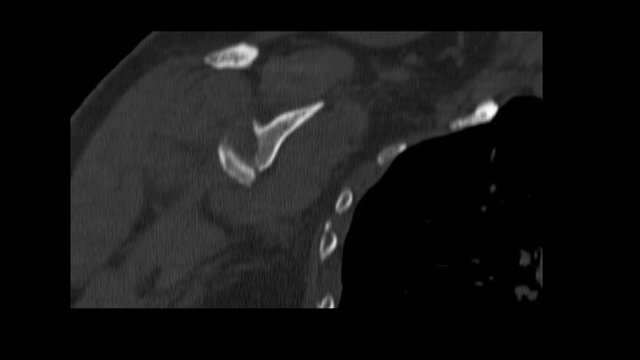 CT Scan shoulder. Fracture posterior half of glenoid with posterior dislocation of bone fragment. Irregular transverse fracture at body of scapula.Fracture anterolateral of rib.Medical footage concept