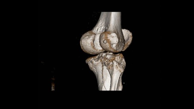 CT Scan knee of the patient periarticular injuries fracture of the proximal tibia frequently associated with soft tissue injuries.Medical footage concept.