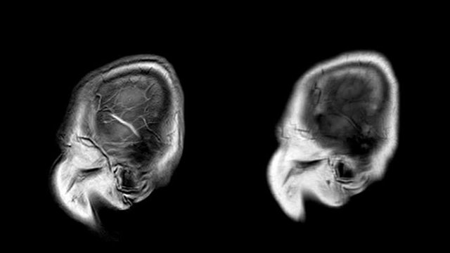 MRI OF BRAIN Impression: A 5cm isodensity mass with ill defined margin and surrounding edema at Left frontal lobe.Brain MRI, head scans and tumor detection. Diagnostic medical tool.