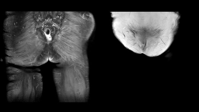 Magnetic Resonance Imaging (MRI) of both hip sagittal plane. Finding A large mixed heterogeneous fluid collection, located at intramuscular area of right gluteus maximus and gluteus medius muscles.