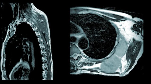 Magnetic resonance (MRI) of Shoulder Joint Impression:The mass Lt.shoulder DDx.soft tissue sarcoma & metastasis.Medical healthcare footage concept.