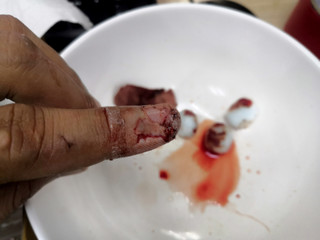 Finger wound,Physical injury blood wound human hand finger nail.Injured finger with bleeding open cut.