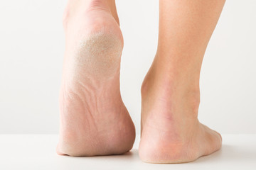 Young woman standing on floor and showing foot with dry skin. Closeup. Light gray background.
