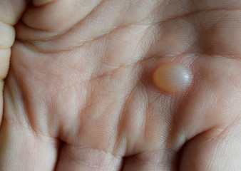 Water blister on hand from hot water.