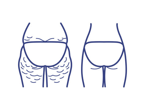 Reduce fat and cellulite at buttock. Vector line Illustration about body care. Before and after