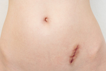 Concept of appendicitis removal. Scar on the skin after removing the appendix, fresh wound, close-up