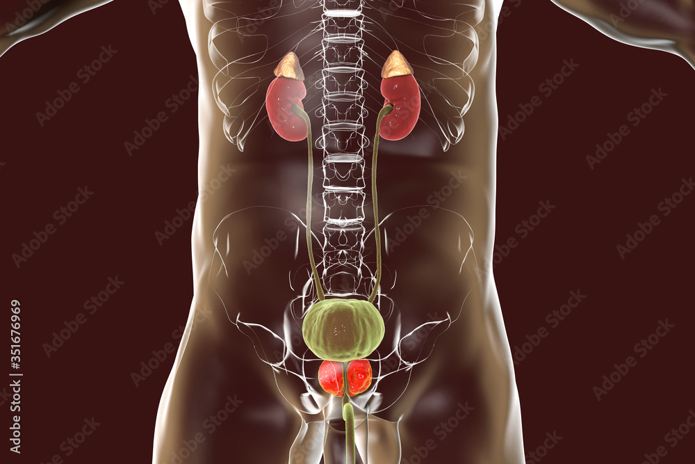 Poster benign prostatic hyperplasia