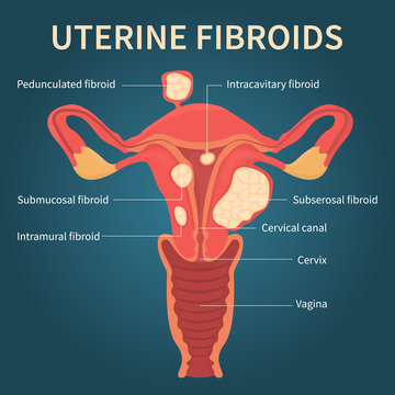 Flat vector illustration of uterine fibroids, myoma, uterine leiomyomas on dark blue background mentioning pedunculated, intracavitary, submucosal, subserosal fibroids and cervix, vagina.