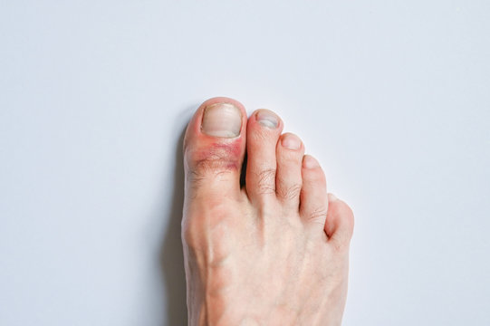Damaged big toe on a white background