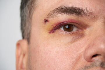 Fototapeta premium close view of a black eye, man's face with a hematoma