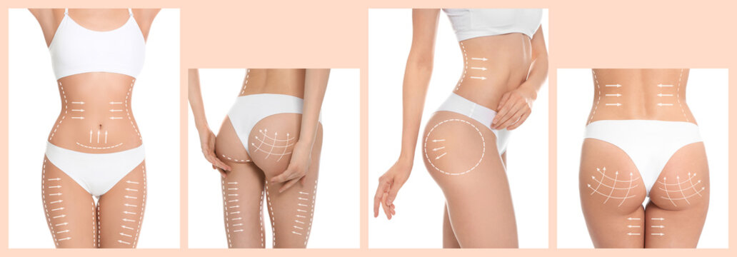 Photos of young woman with marks on body against white background, collage. Cosmetic surgery concept
