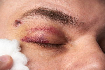 close view of a black eye, man's face with a hematoma
