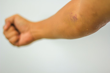Bruises from blood collection . Purple bruise on the arm. serective focus.