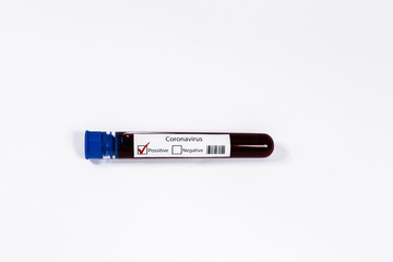 Blood test samples for presence of coronavirus (COVID-19) tube containing a blood sample that has tested positive for coronavirus.