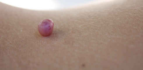 Hemangioma capilar adquirido en la espalda de una mujer jóven en tratamiento con anticonceptivos orales.