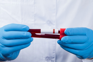 Coronavirus 2019-nCoV Blood Sample.