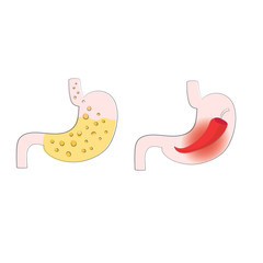 Visualization of stomach heartburn, gastritis and acid reflux, ulcers.  
Strong burning sensation and a full stomach of hydrochloric acid. 
Vector illustration of a disease of the stomach