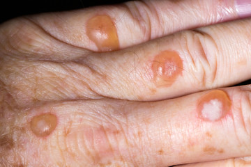 Blisters caused by cryotherapy fro solar keratosis on skin of 64 year old Caucasian male.