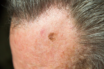Lentigo maligna (melanoma in situ) on forehead of 64 year old male