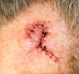 Fototapeta premium Sutures in cut using flap technique on face for removal of melanoma in situ.