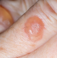 Blisters caused by cryotherapy fro solar keratosis on skin of 64 year old Caucasian male.