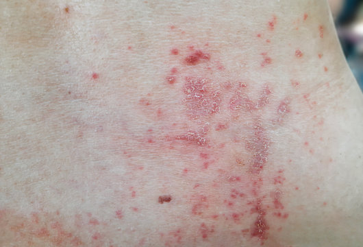 Skin disease prickly heat rash or miliaria on back skin of asian woman. Healthcare skin cause for outdoor work in sunny with hot weather and have sweat. Dermatologist and treatment medication concept.