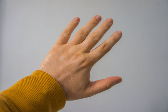 A caucasian man's hand covered with white vitiligo spots. Vitiligo is an autoimmune disorder that causes skin pigment loss in form of white patches. It is not contagious and does not cause pain.
