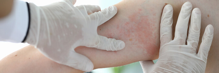 Close-up examination by doctor, allergic rash.