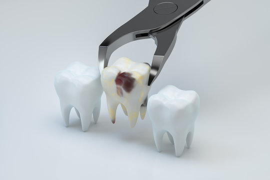 The sick tooth being pulled out, 3d rendering.