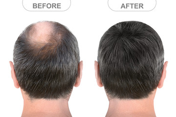 Back view of male head before and after hair extensions - obrazy, fototapety, plakaty