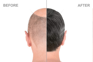 Back view of male head before and after hair extensions